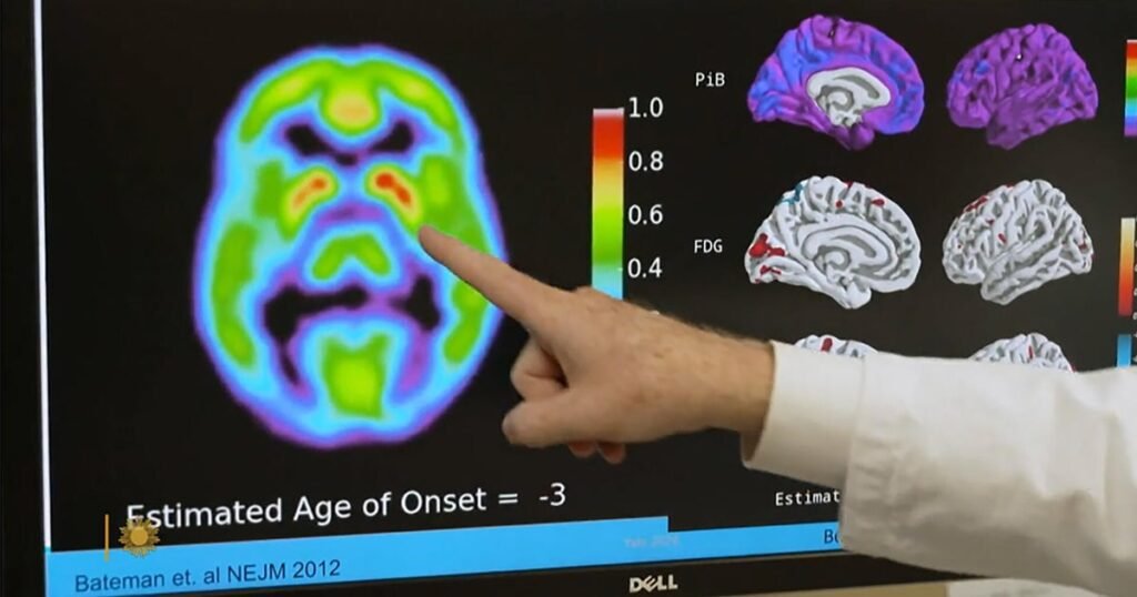 Alzheimer’s blood test may predict who’s likely to develop symptoms in 5 to10 years