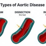 aortic disease